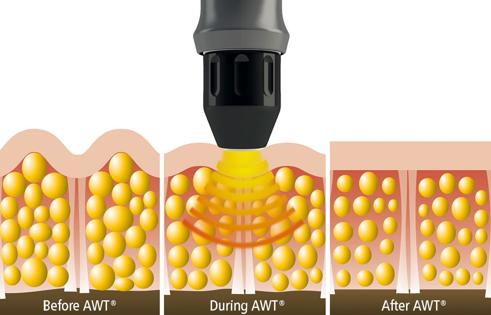 ED Treatment Utah - Acoustic Wave Therapy and Comprehensive Solutions